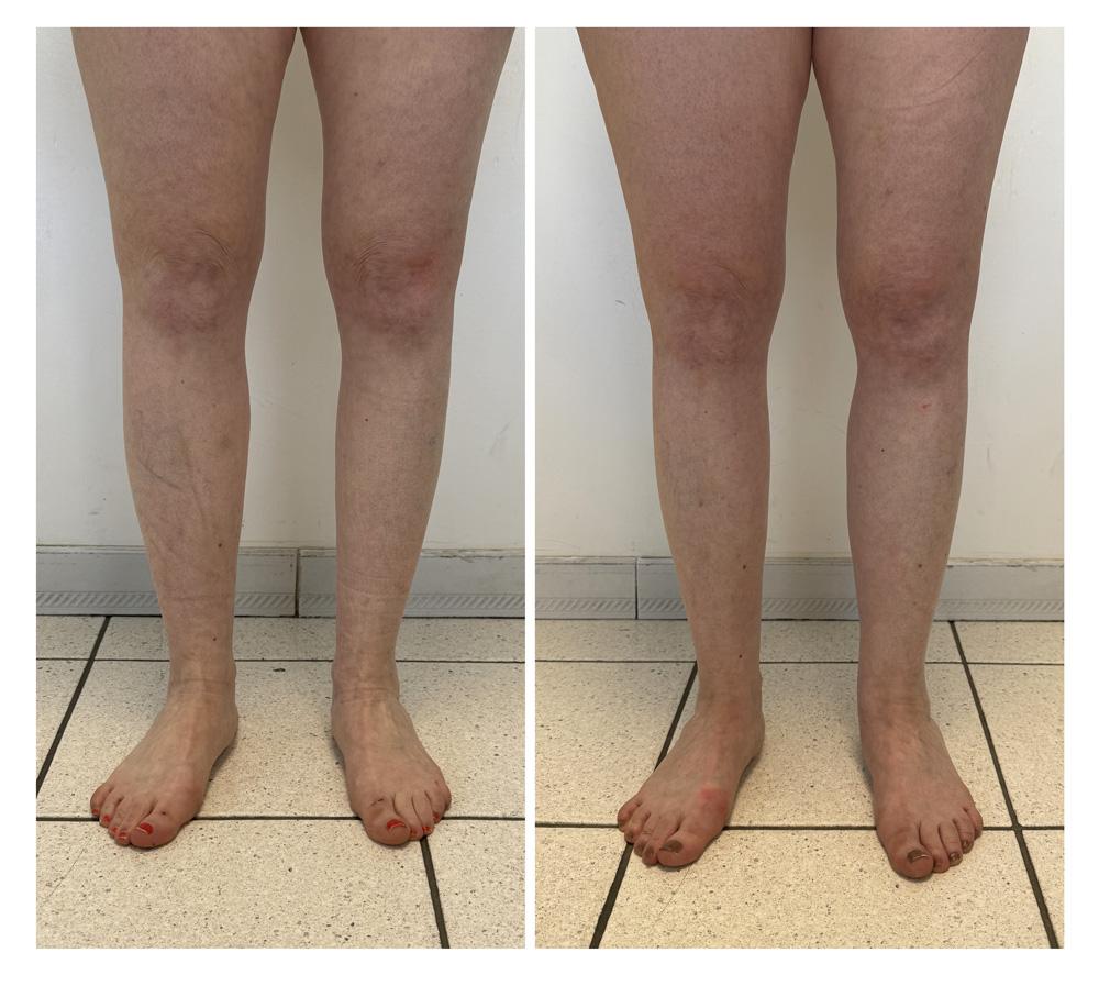 Augmentation du mollet - Patient 06