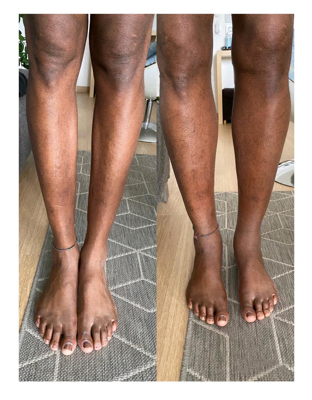 Augmentation du mollet - Patient 07