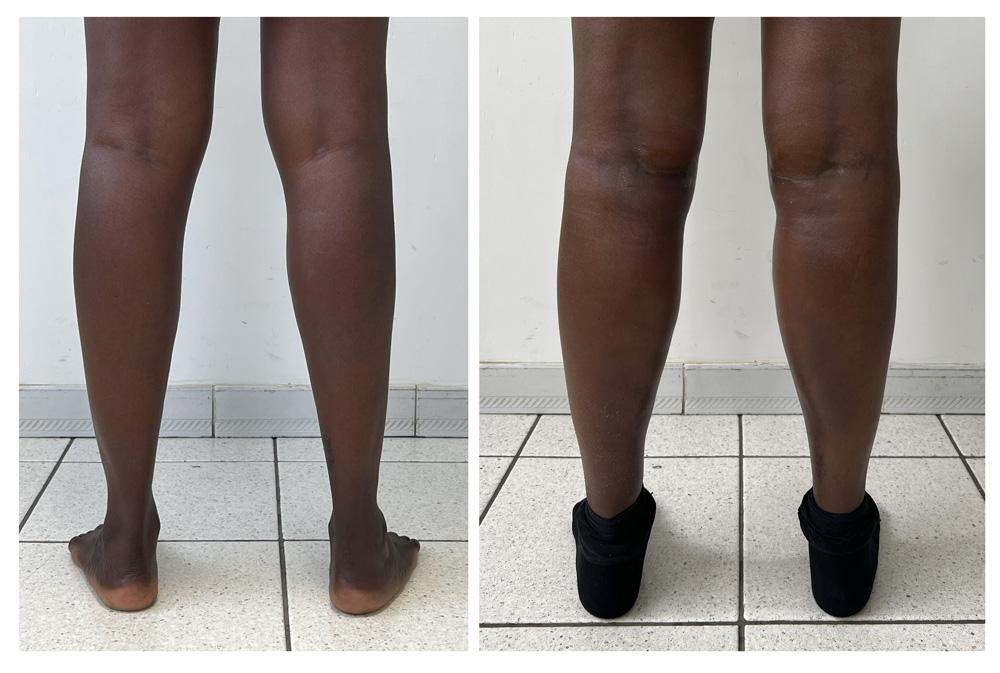 Augmentation du mollet - Patient 09