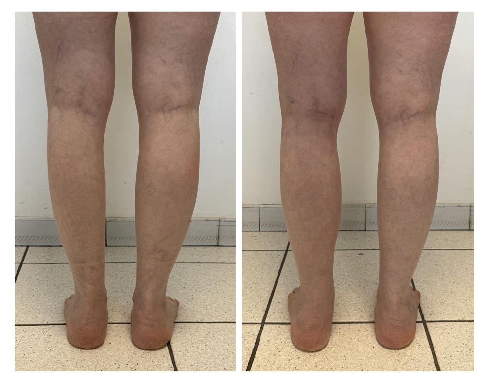 Augmentation du mollet - Patient 10