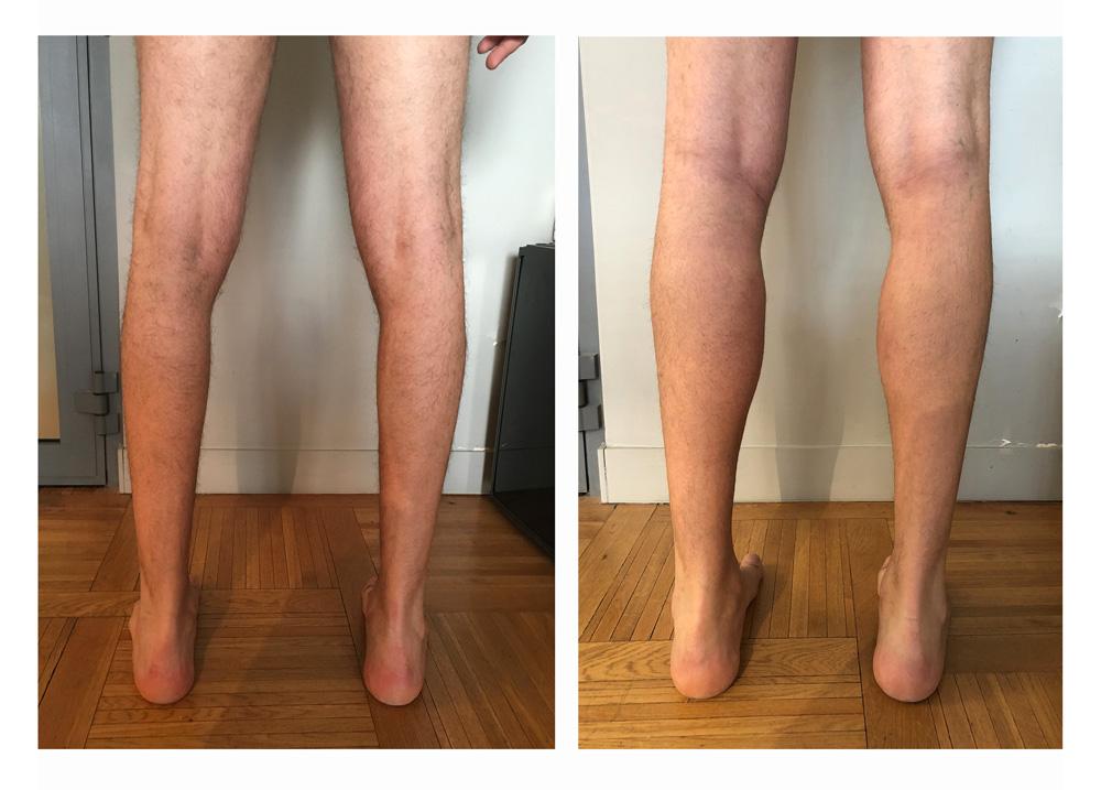 Augmentation du mollet - Patient 11