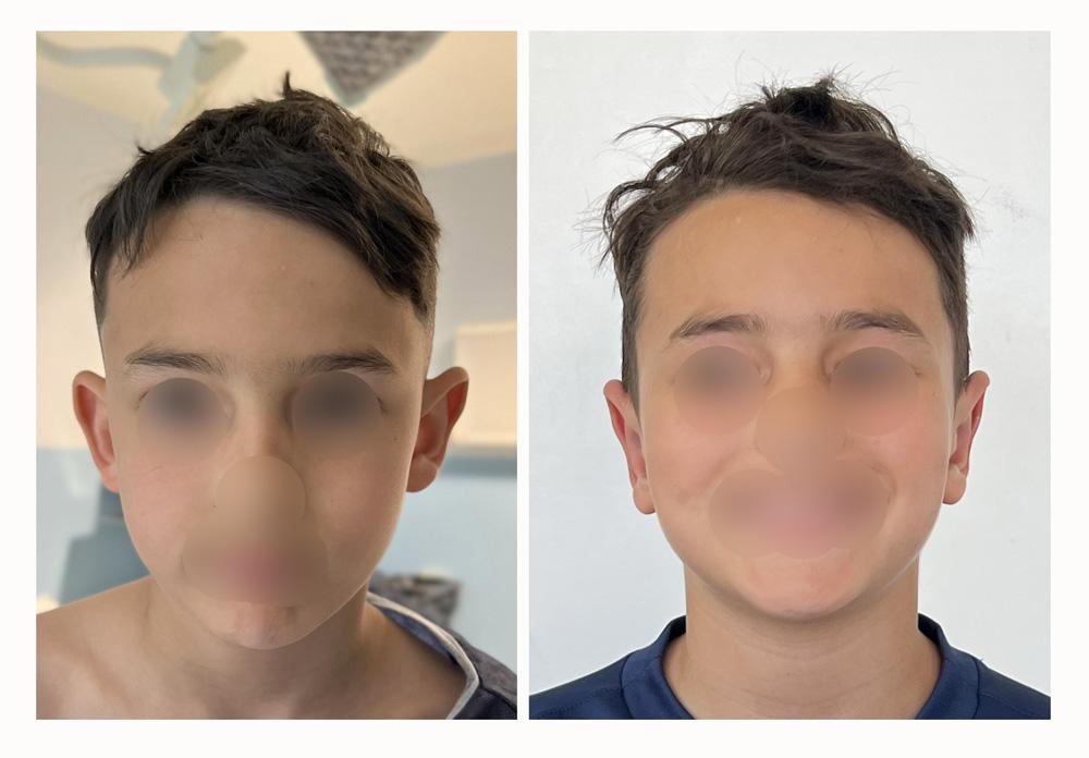 Otoplastie - Patient 01 avant