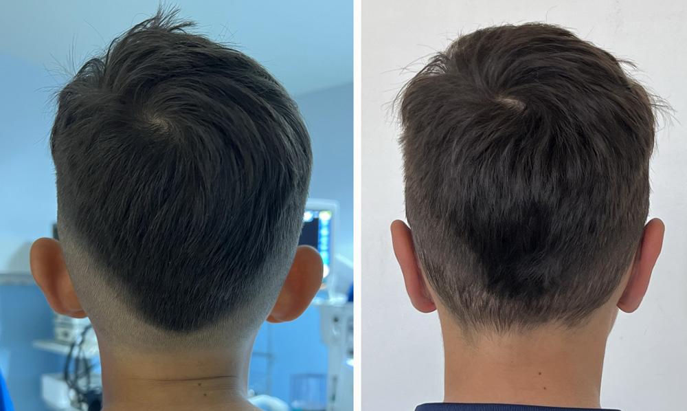 Otoplastie - Patient 01 apr&egrave;s