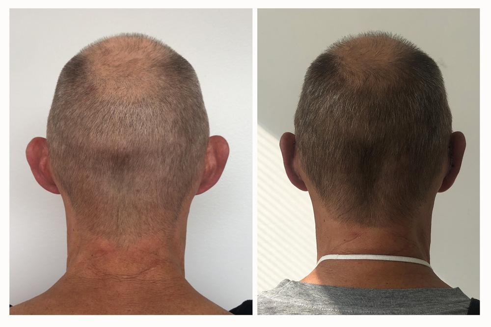 Otoplastie - Patient 02