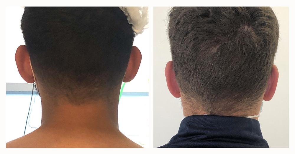 Otoplastie - Patient 03 apr&egrave;s