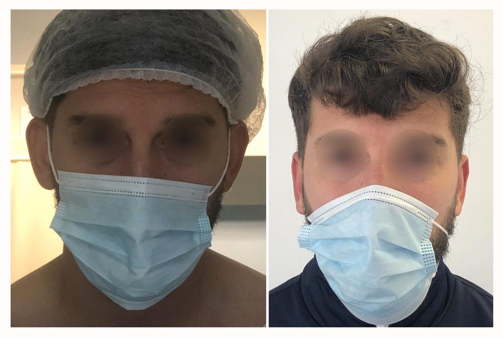 Otoplastie - Patient 03 avant