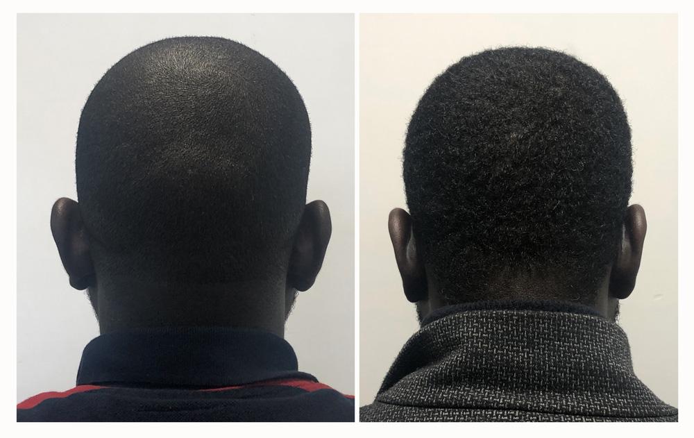 Otoplastie - Patient 04