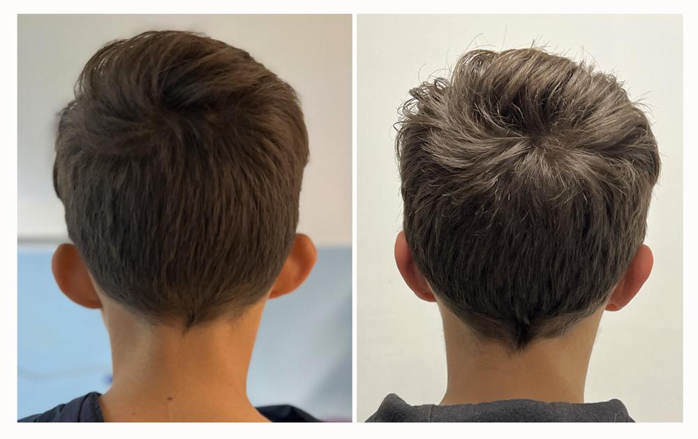 Otoplastie - Patient 05