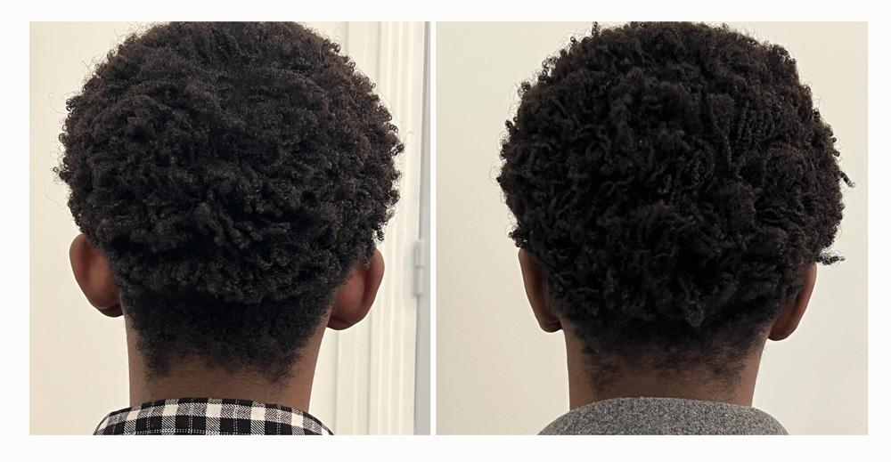 Otoplastie - Patient 08