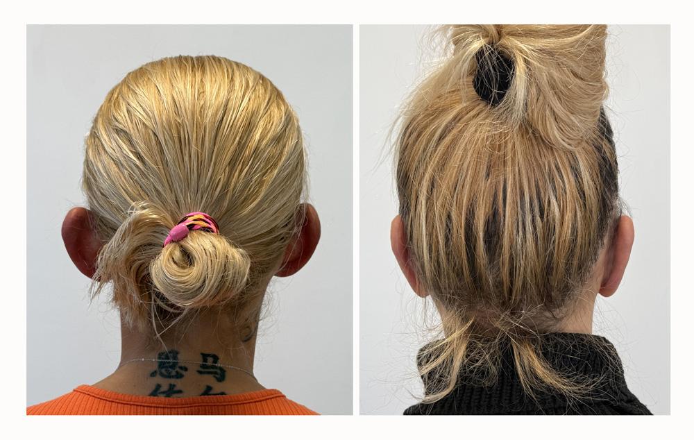 Otoplastie - Patient 10 apr&egrave;s