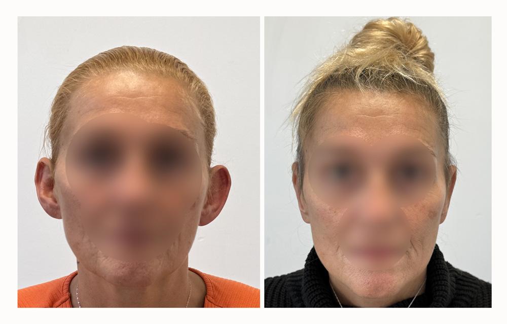 Otoplastie - Patient 10 avant