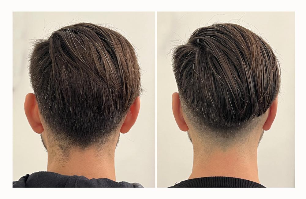 Otoplastie - Patient 11