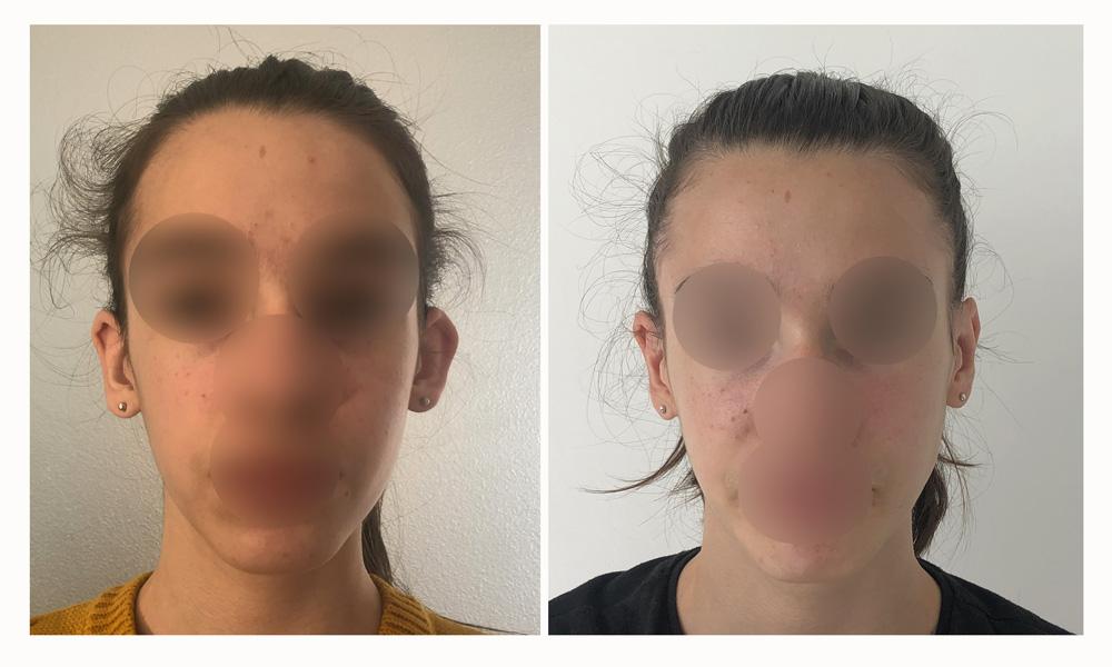 Otoplastie - Patient 12 avant