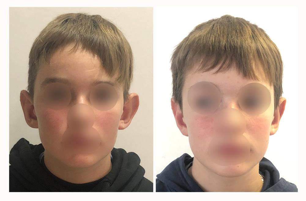 Otoplastie - Patient 13 devant