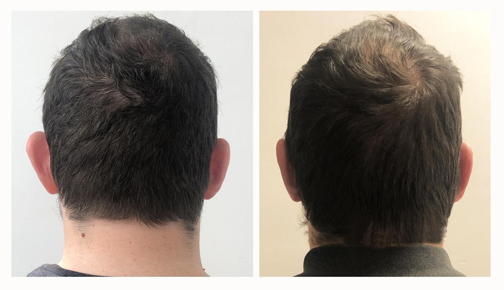 Otoplastie - Patient 14 derriere