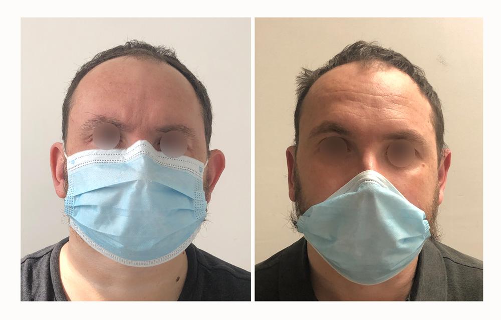 Otoplastie - Patient 14 devant