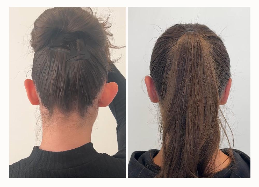 Otoplastie - Patient 15 derriere