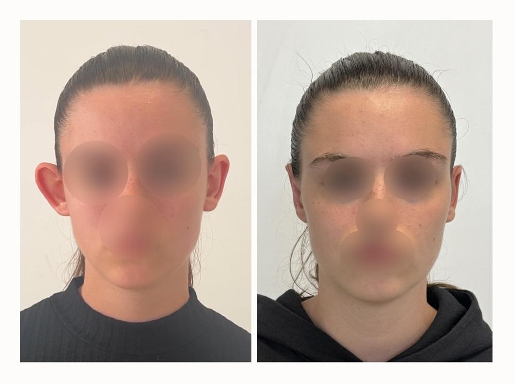 Otoplastie - Patient 15 devant