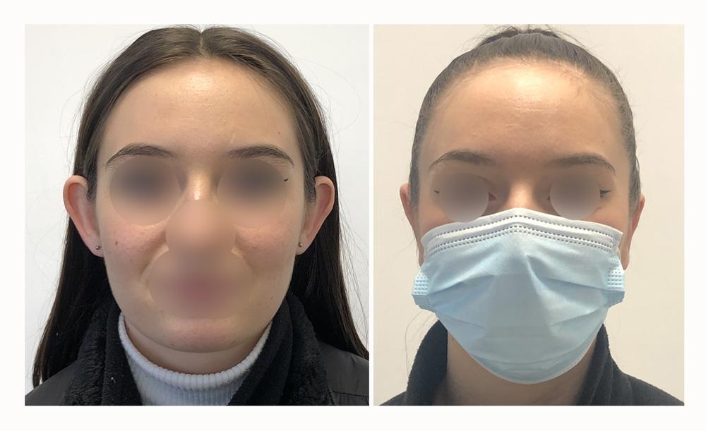 Otoplastie - Patient 16