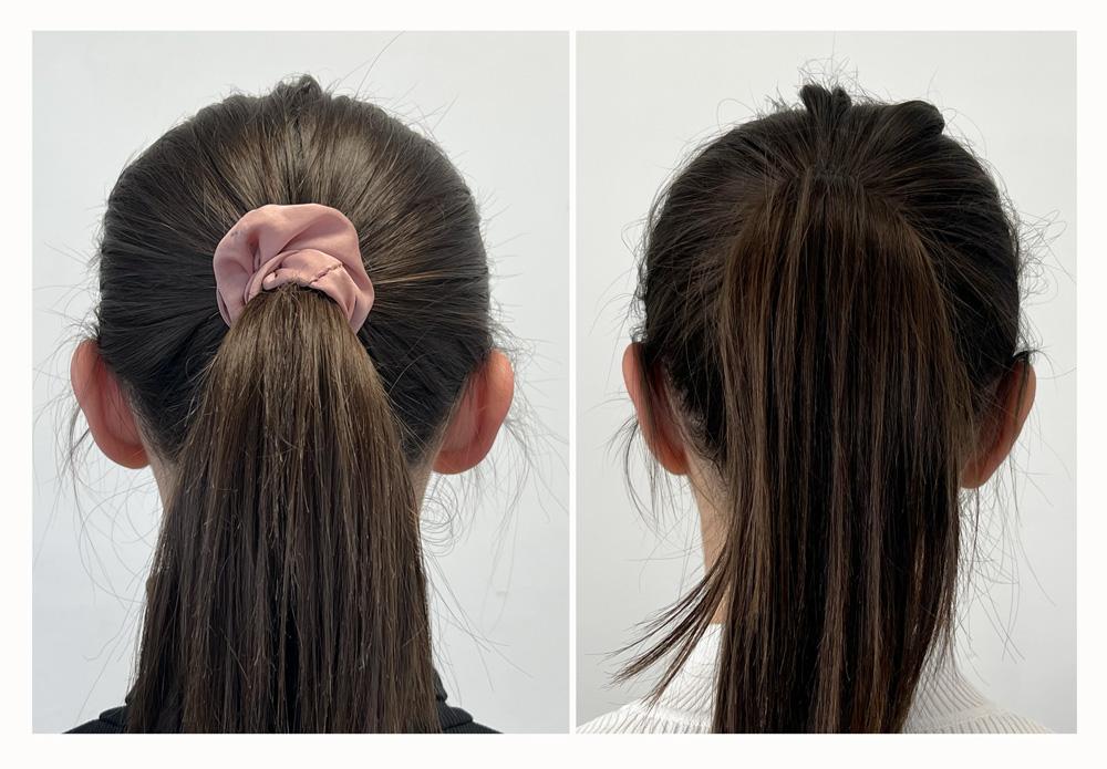 Otoplastie - Patient 18 derriere