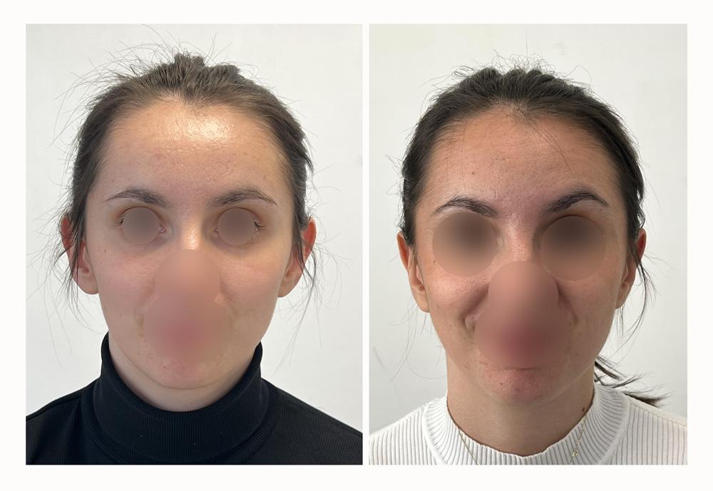 Otoplastie - Patient 18 devant