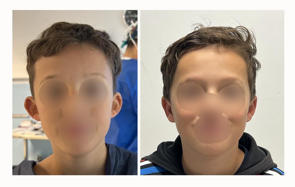 Otoplastie - Patient 19