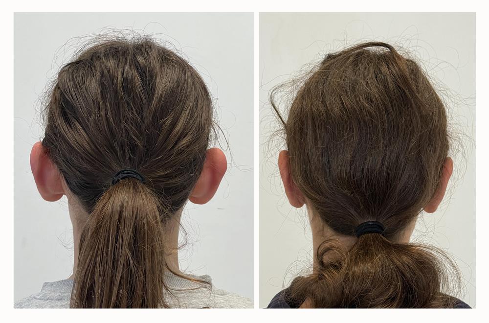 Otoplastie - Patient 21 derriere