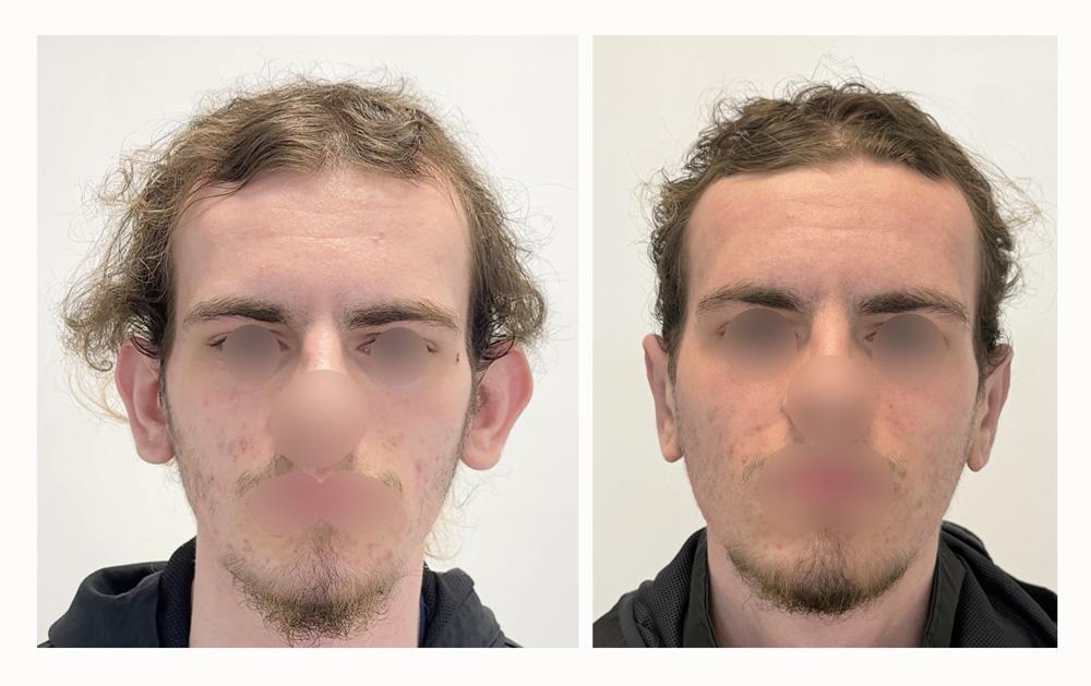 Otoplastie - Patient 30