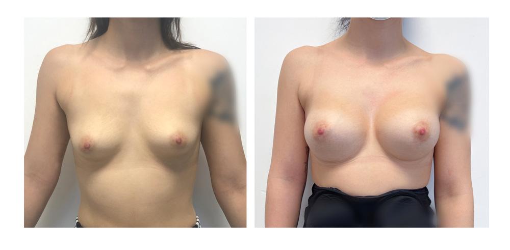 Augmentation mammaire par proth&egrave;ses - Patiente 00
