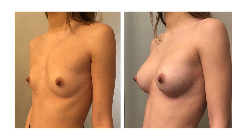 Augmentation mammaire par proth&egrave;ses - Patiente 01