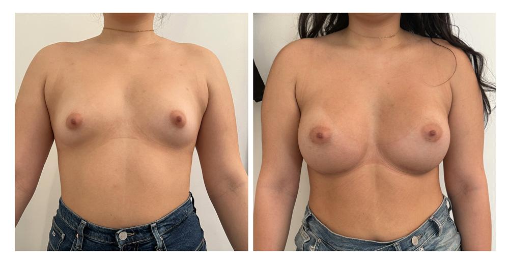 Augmentation mammaire par proth&egrave;ses - Patiente 04