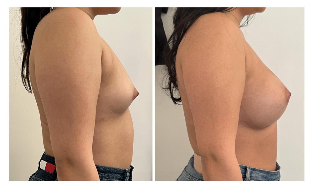 Augmentation mammaire par proth&egrave;ses - Patiente 05