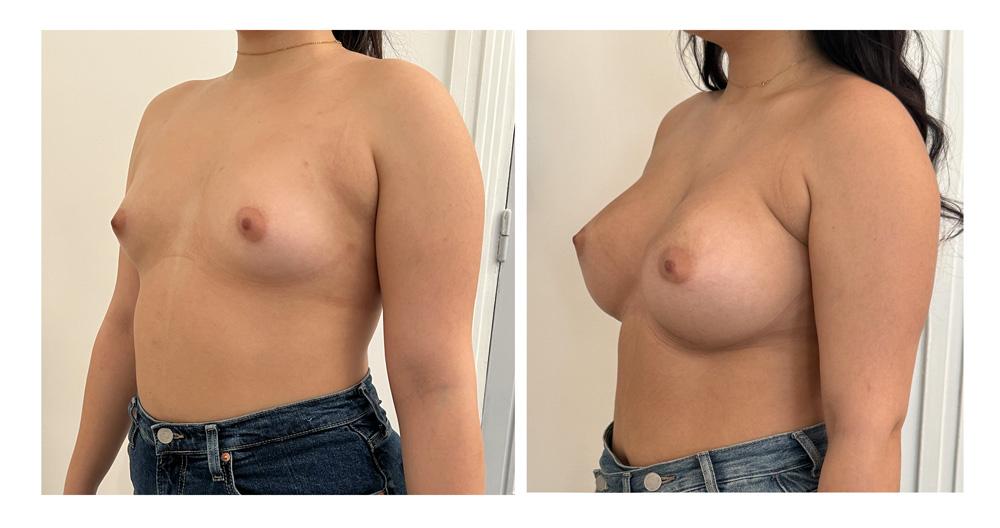 Augmentation mammaire par proth&egrave;ses - Patiente 06