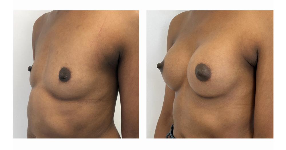 Augmentation mammaire par proth&egrave;ses - Patiente 07