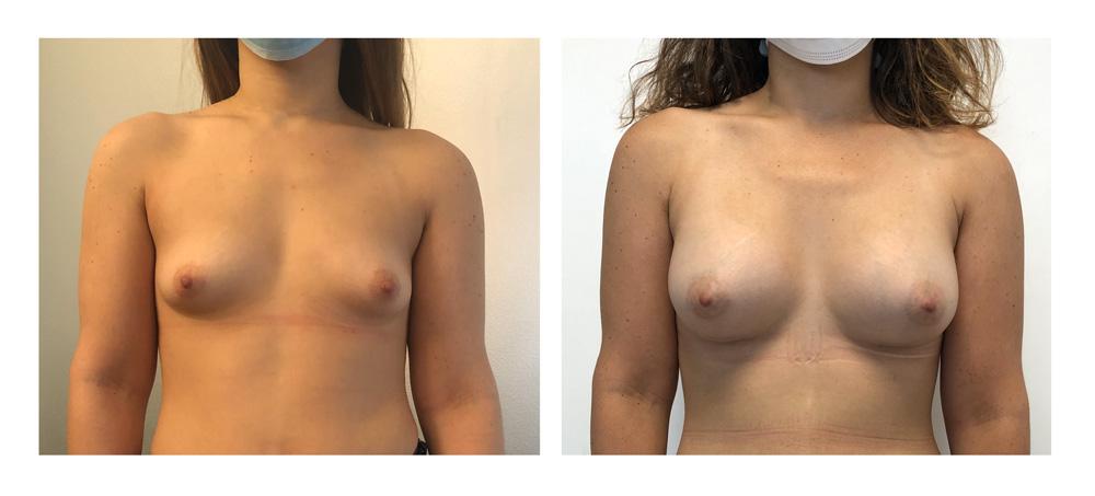 Augmentation mammaire par proth&egrave;ses - Patiente 08