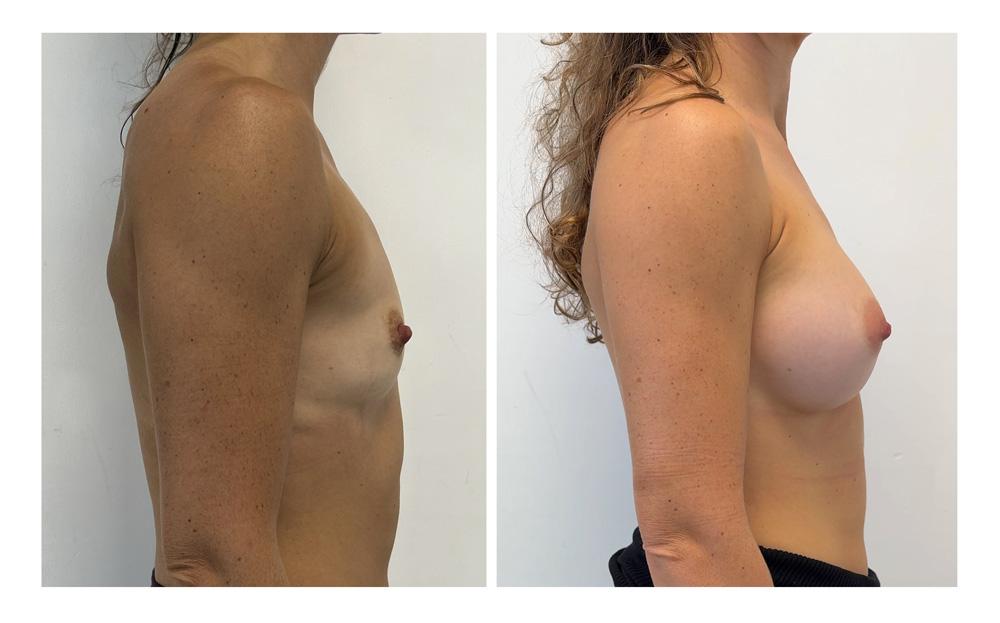 Augmentation mammaire par proth&egrave;ses - Patiente 09