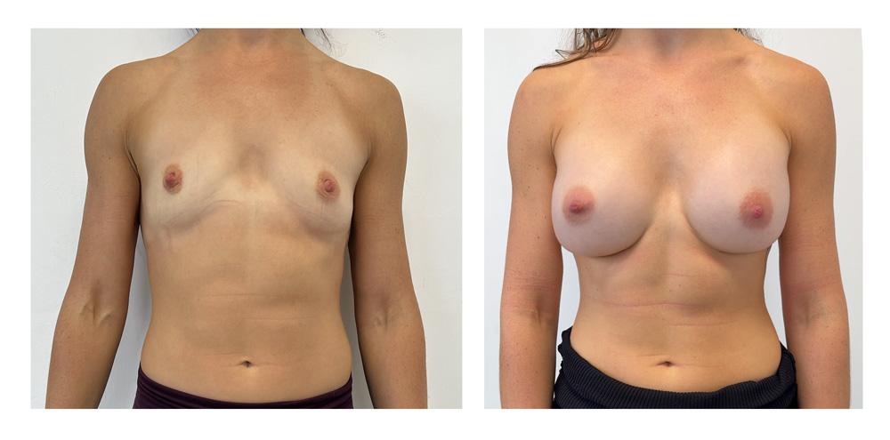 Augmentation mammaire par proth&egrave;ses - Patiente 10