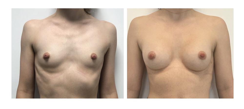 Augmentation mammaire par proth&egrave;ses - Patiente 11