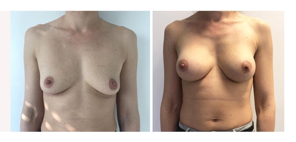 Augmentation mammaire par proth&egrave;ses - Patiente 12