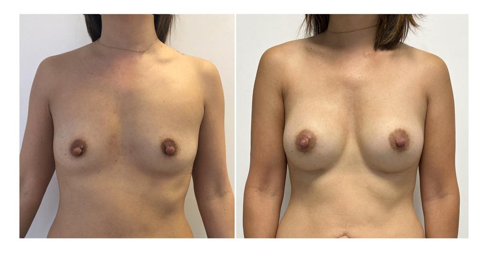 Augmentation mammaire par proth&egrave;ses - Patiente 15