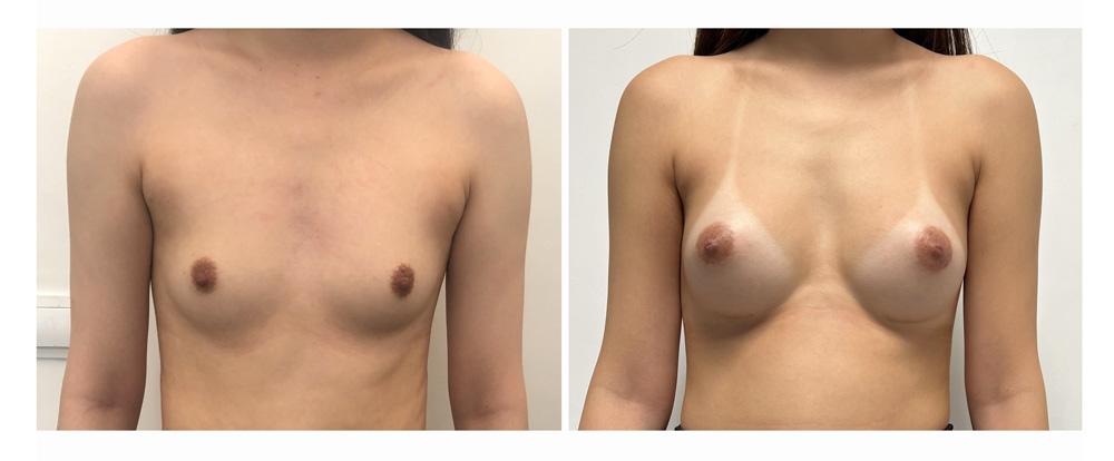 Augmentation mammaire par proth&egrave;ses - Patiente 17