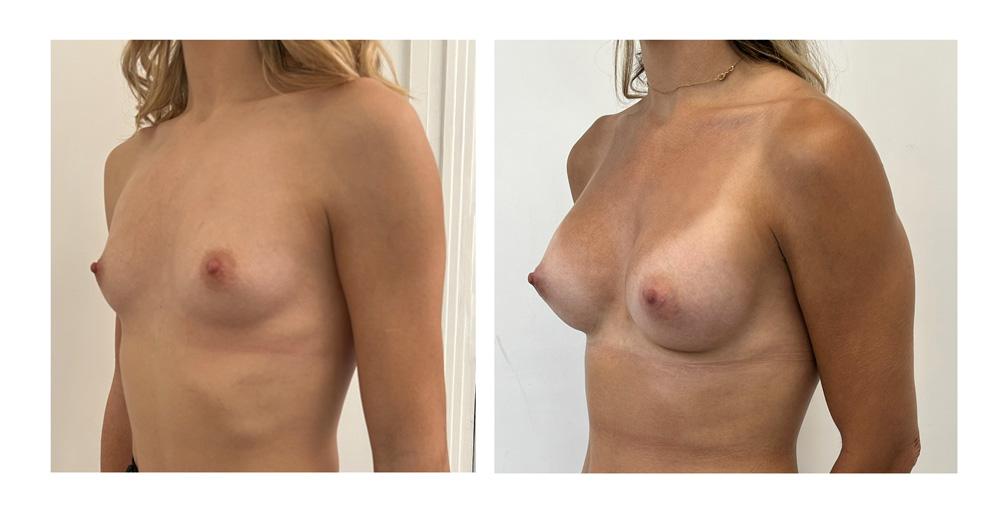 Augmentation mammaire par proth&egrave;ses - Patiente 19