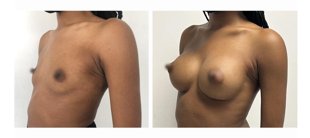 Augmentation mammaire par proth&egrave;ses - Patiente 25