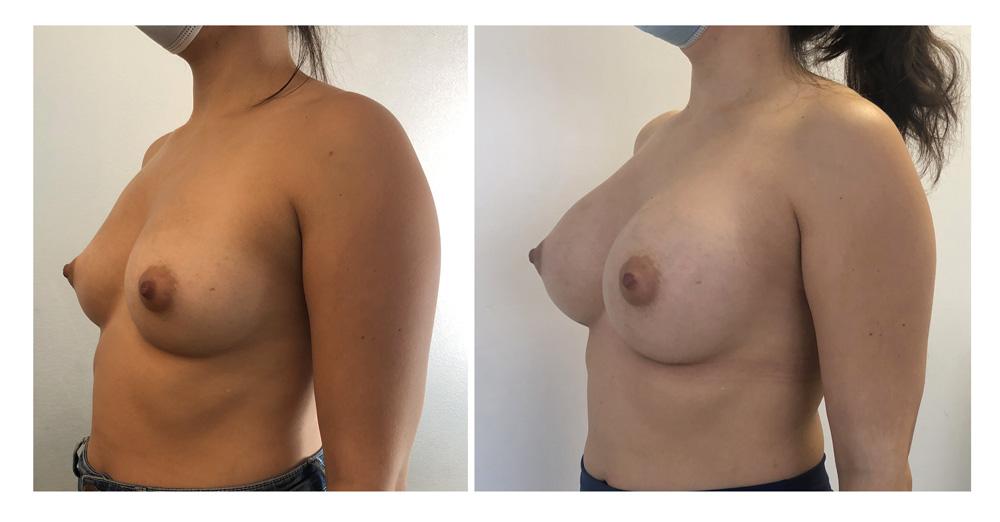 Augmentation mammaire par proth&egrave;ses - Patiente 26
