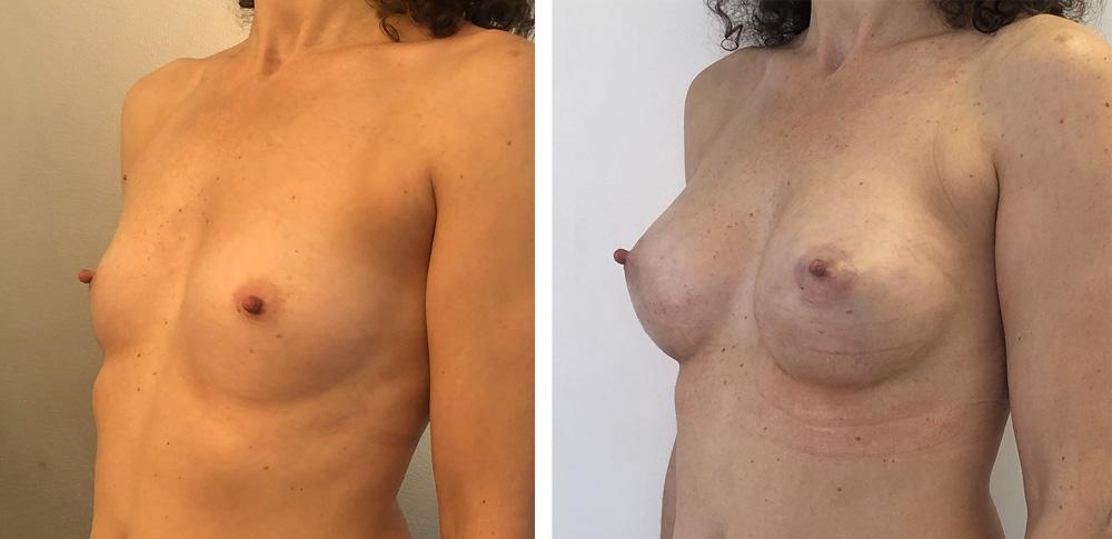 Augmentation mammaire par proth&egrave;ses - Patiente 27