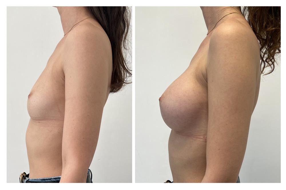 Augmentation mammaire par proth&egrave;ses - Patiente 28