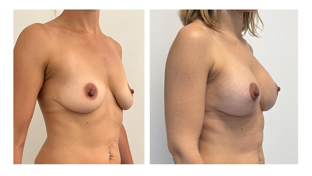 Ptose mammaire - Patient 01