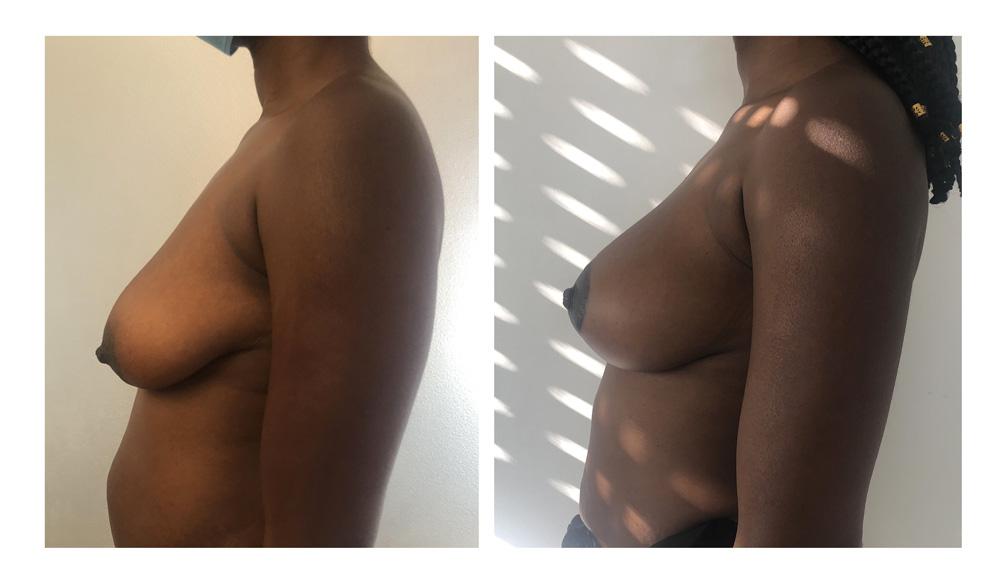 Ptose mammaire - Patient 02