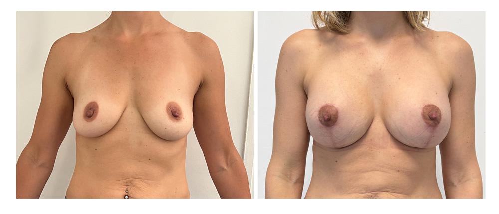 Ptose mammaire - Patient 04