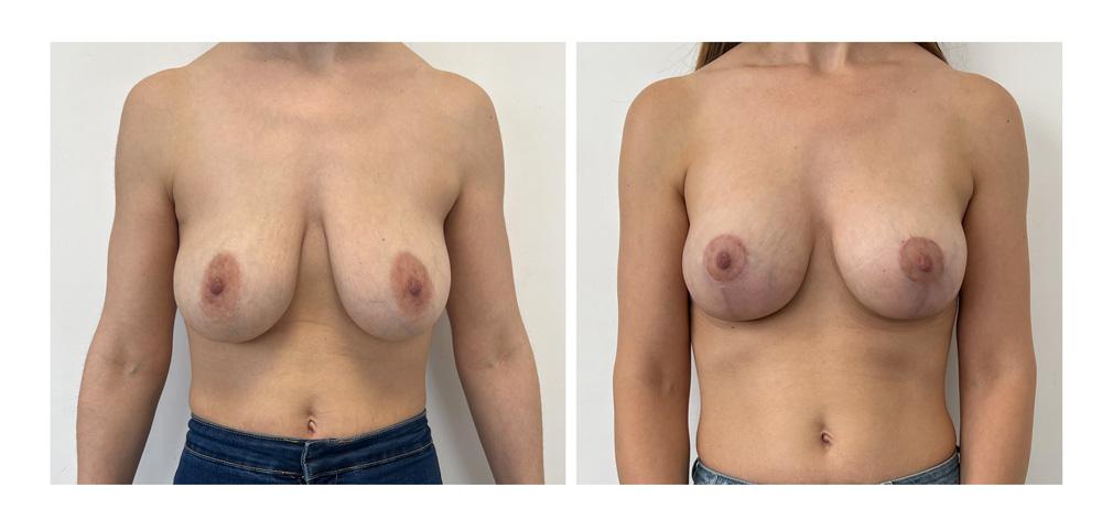 Ptose mammaire - Patient 05